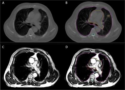 Initial Clinical Experience of MR-Guided Radiotherapy for Non-Small Cell Lung Cancer